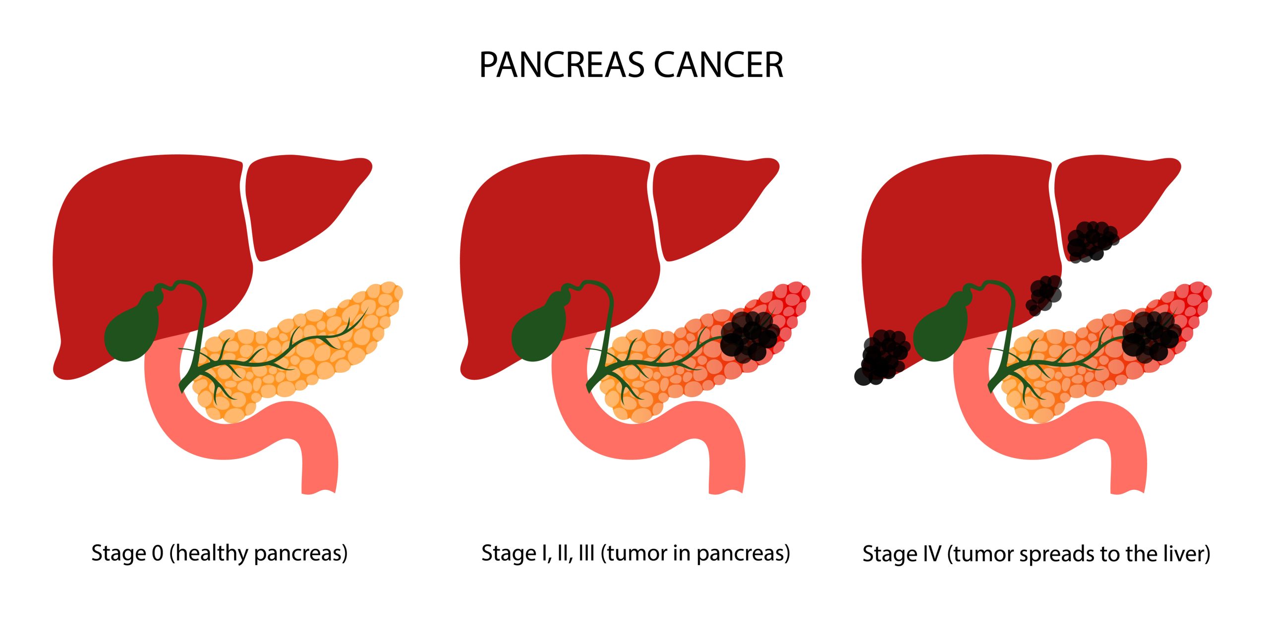 Stages Of Cancer Scaled | What Is Pancreatic Cancer? | National Pancreatic Cancer Foundation