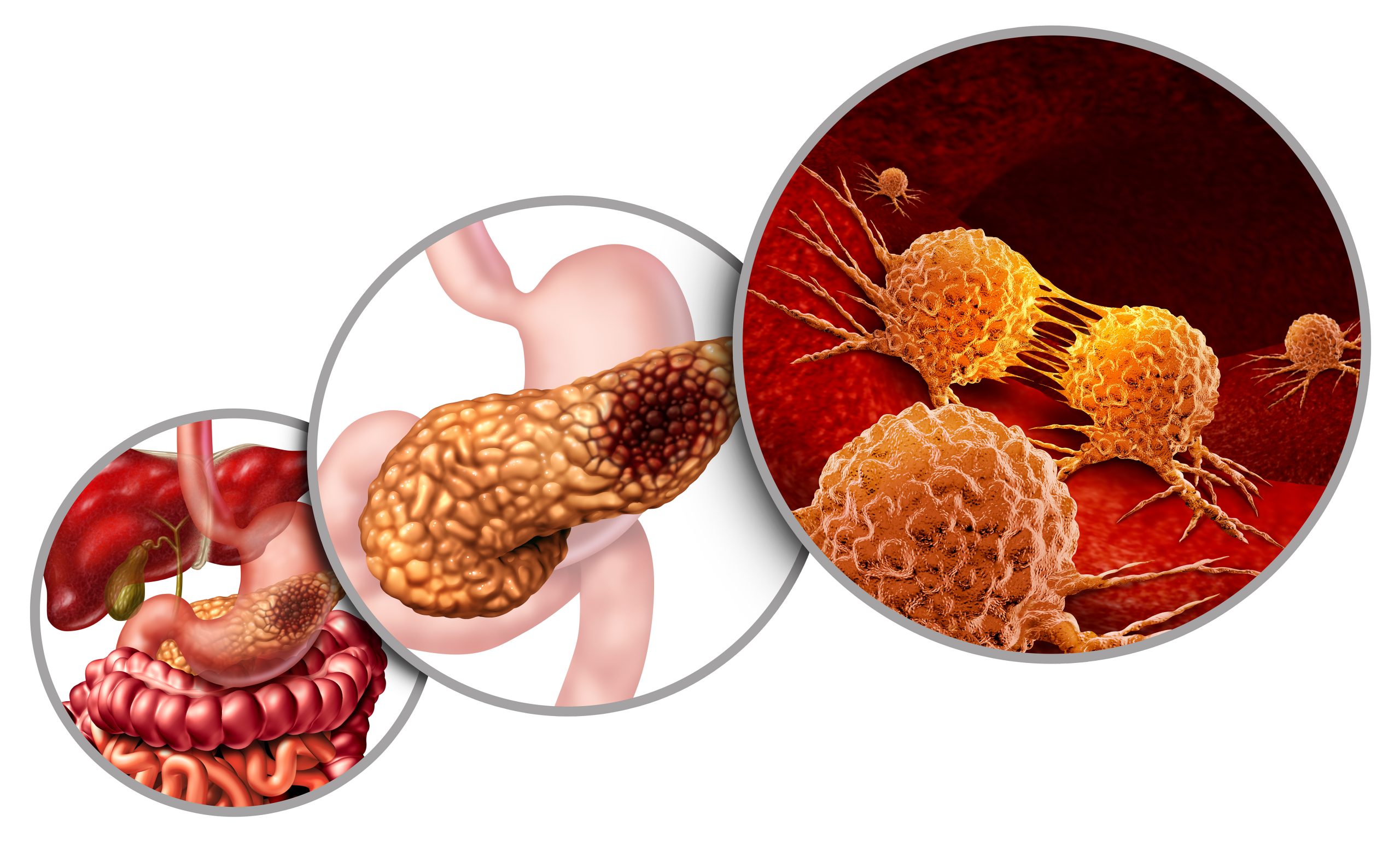 What is pancreatic Cancer scaled