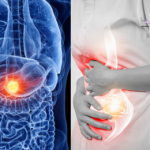 Early Signs of Pancreatic Cancer: Recognition Could Save Your Life