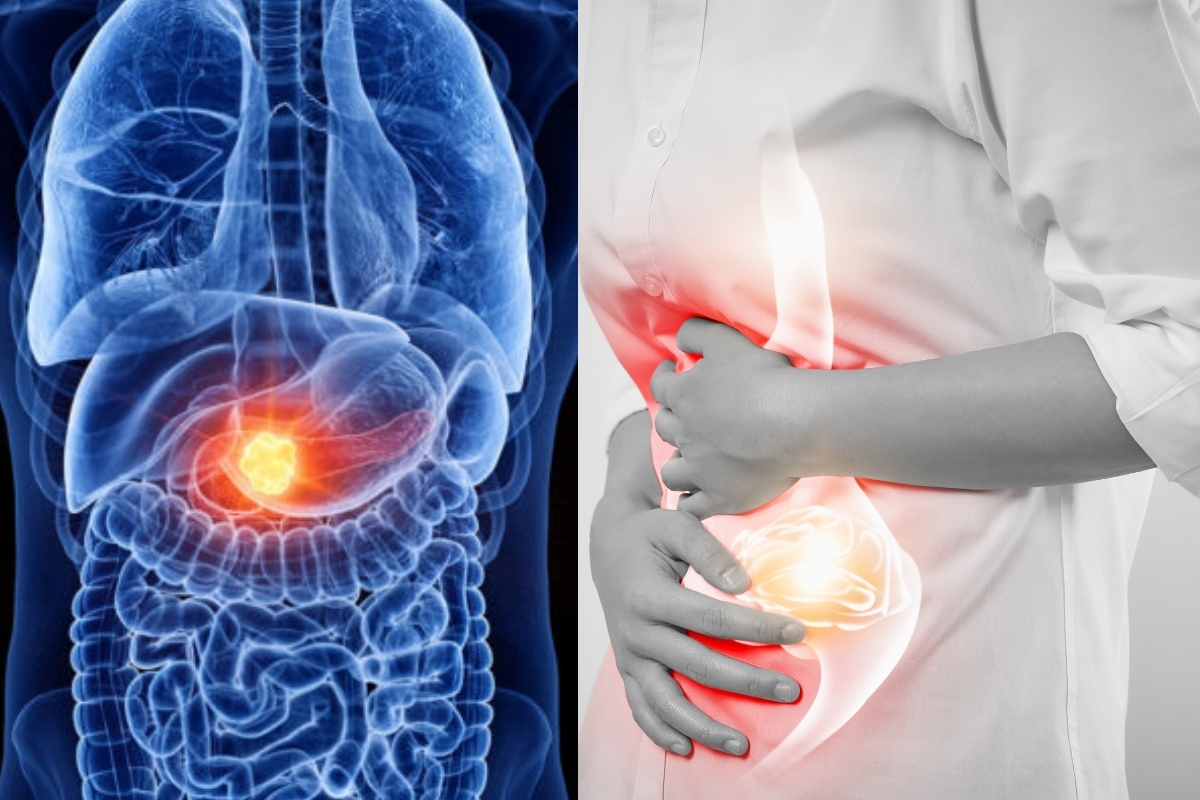 Early Signs of Pancreatic Cancer