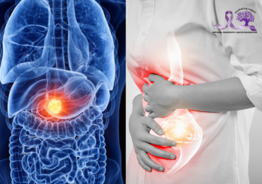 Early Signs of Pancreatic Cancer