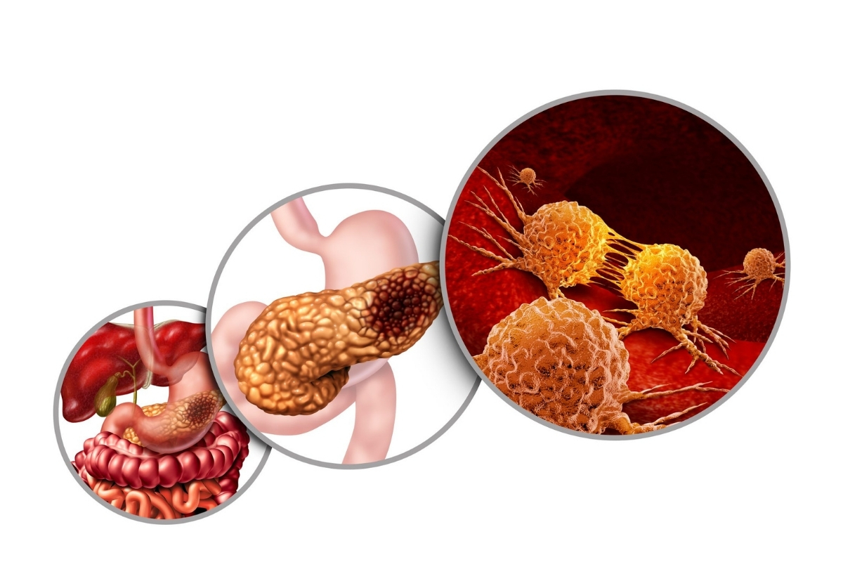 How Is Pancreatic Cancer Diagnosed ()