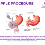 Understanding the Whipple Procedure for Pancreatic Cancer: A Comprehensive Guide for Patients and Caregivers