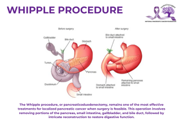 Whipple Procedure