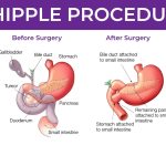 Whipple Procedure: What Patients and Families Need to Know About the Surgery, Recovery, and Outcomes