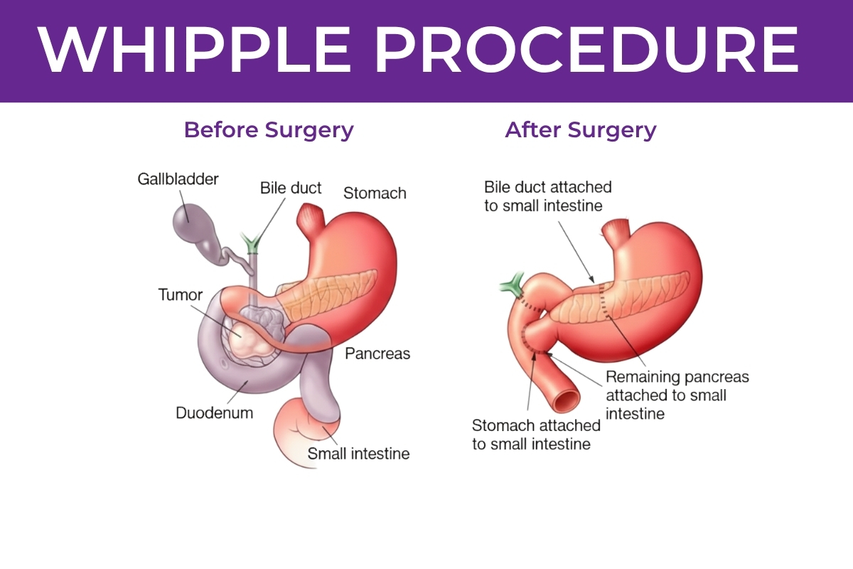 WHIPPLE PROCEDURE