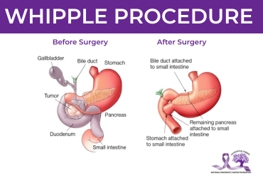 WHIPPLE PROCEDURE