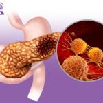 What is Pancreatic Cancer? A Clear, Compassionate Guide for Patients and Families