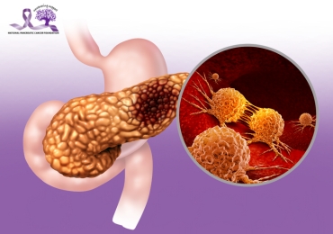 What is Pancreatic Cancer